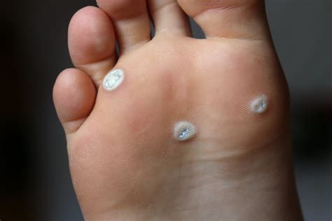 Warts on Foot: Causes, Symptoms, and Effective Removal Methods