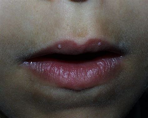 warts on lips images