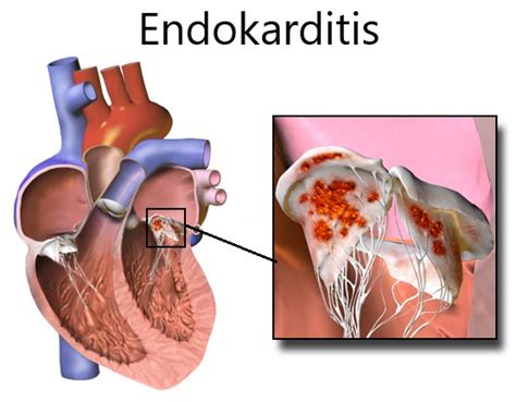 was ist eine endokarditis