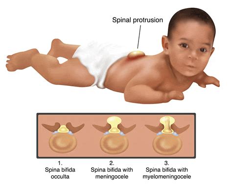 was ist spina bifida