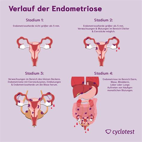 was passiert bei endometriose