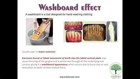 Washboard Effect Definition