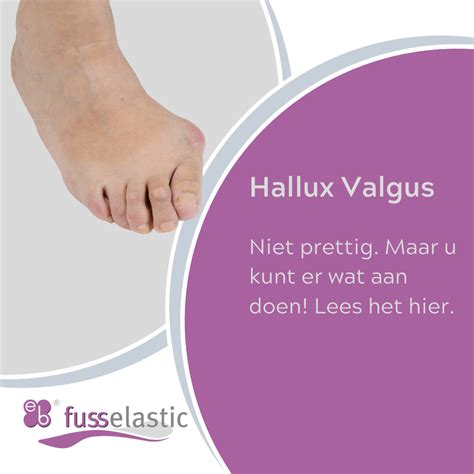 wat is een hallux valgus