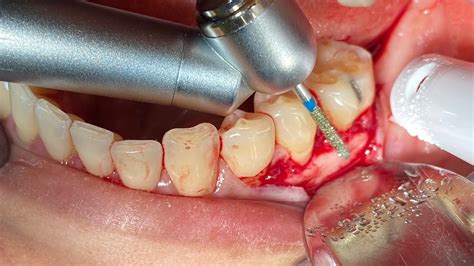 watch osseous dental surgery