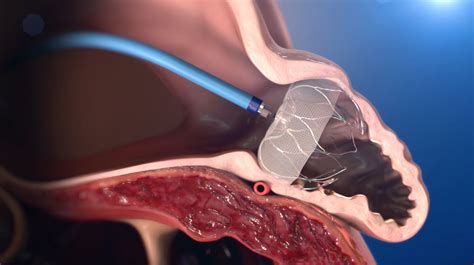 watchman procedure cardiology