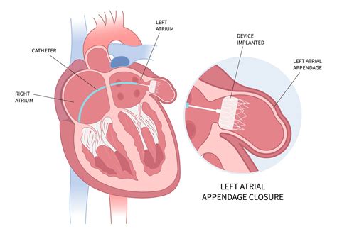 watchman procedure cpt code