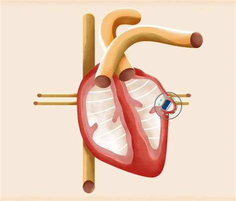 watchman procedure heart