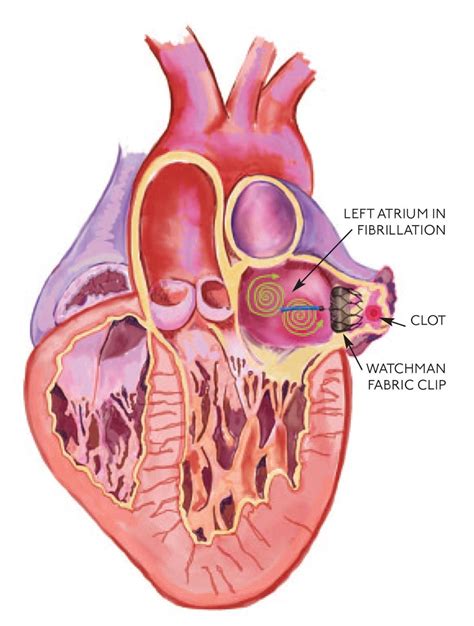 Watchman Vs Maze Procedure