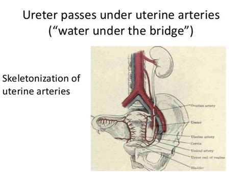 water over the bridge ureter