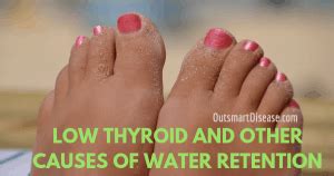 water retention and thyroid issues