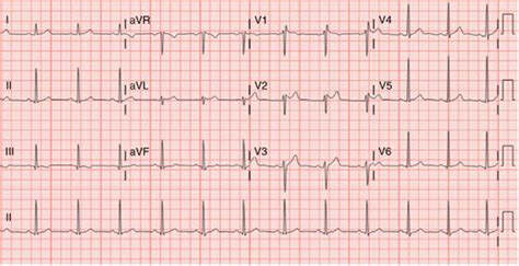 wave imagining saddleback