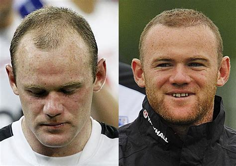 wayne rooney hair before and after