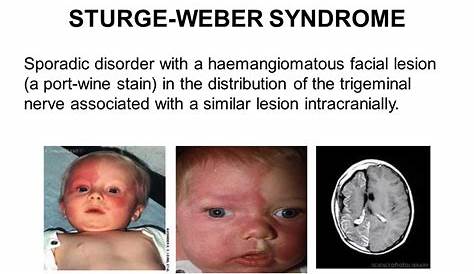 Patient with SturgeWeber syndrome presents with port wine