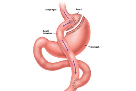 Weight Loss Surgery Jackson Ms