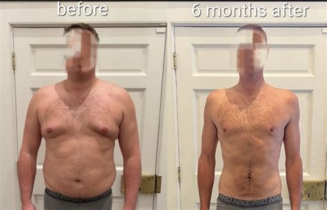 Weight Loss Surgery Nyc