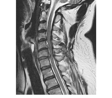 Weighted Blanket Herniated Disc