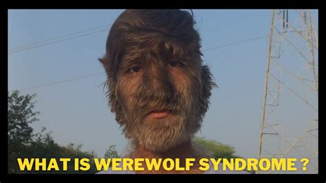 werewolf syndrome