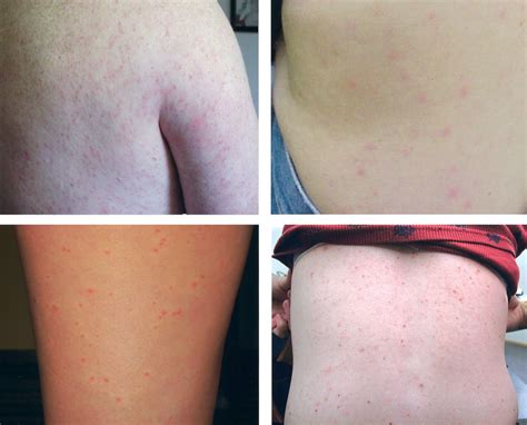 west nile rash pictures