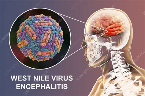 west nile virus encephalitis icd 10