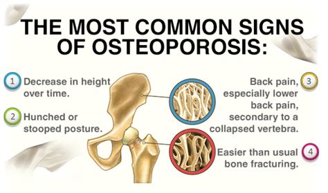 what are signs of osteoporosis