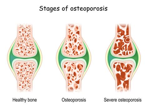 what are the long term effects of osteoporosis