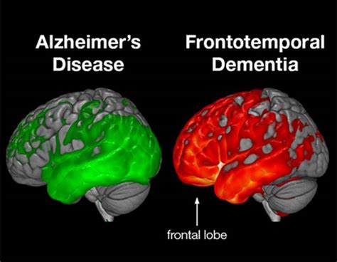 what are the symptoms of frontal lobe dementia