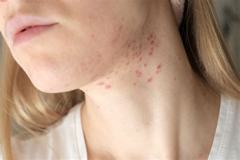 what causes acne on neck