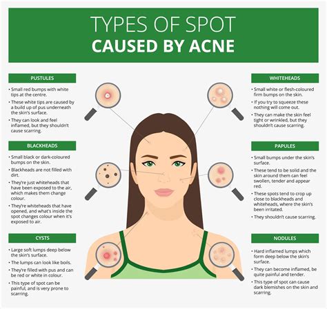 what causes adult acne