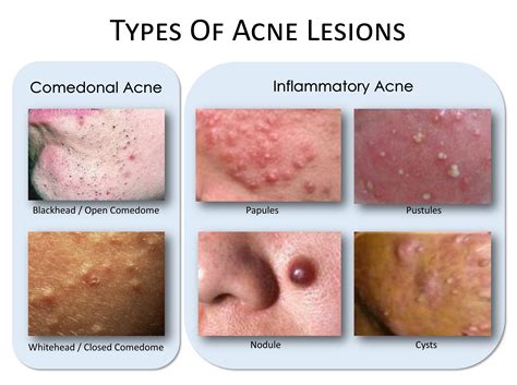 what causes inflammatory acne