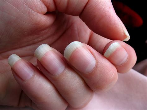 What Causes Nails To Grow Faster Than Usual