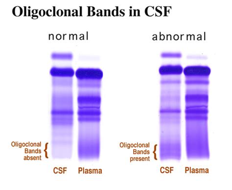 Presence of oligoclonal bands in CSF samples from MS patients. CSF