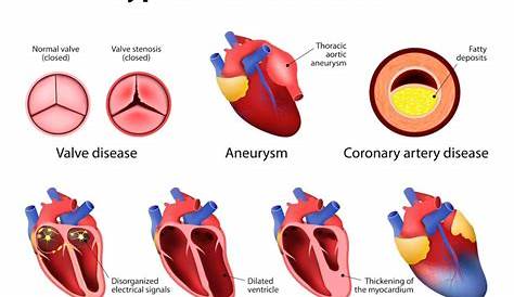 What Does A Heart With Heart Disease Look Like Nutrition nd Prevention