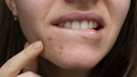 what does acne around the mouth mean