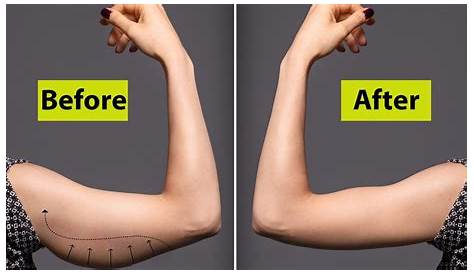 What Does Arm Fat Look Like Causes Upper ? Losing From s