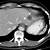 what does low attenuation in the liver mean