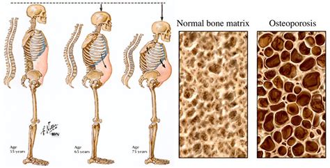 what does osteoporosis mean
