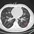 what does tree-in-bud in lungs mean