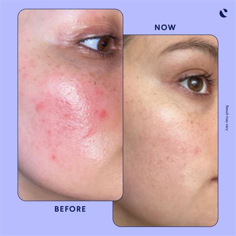 what does tretinoin do for acne