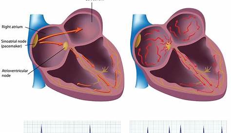 Atrial Fibrillation The Heart & Diving DAN Health & Diving