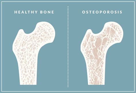 what is osteoporosis and how does it develop
