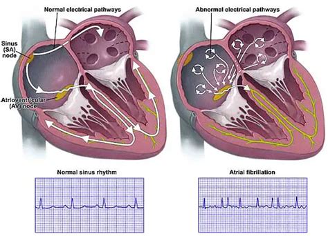 Paroxysmal atrial fibrillation during acute myocardial infarction