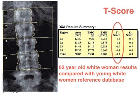 what is severe osteoporosis t score