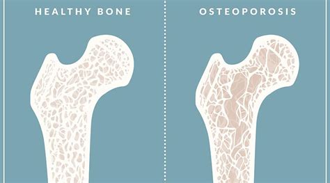 what is the shot for osteoporosis
