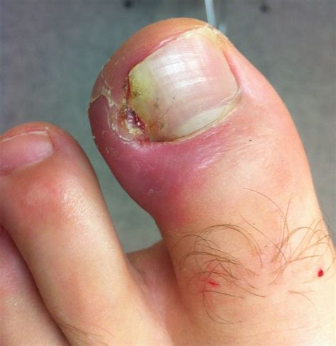 What You Should Know After Ingrown Toenail Surgery