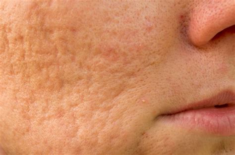what to do for acne scars