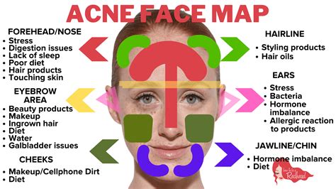 what your acne means