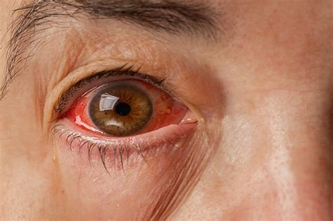 what's red eye disease