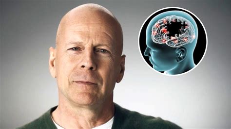 what's the disease that bruce willis has