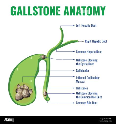 Understanding What a Gallstone Is and How It Affects Your Health