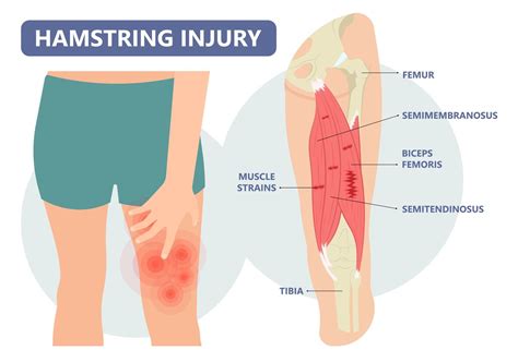 Understanding What a Hamstring Strain Is and How to Recover